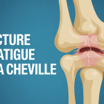Schéma cheville fracture de fatigue microfissure