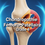 Chondropathie fémoro-patellaire grade 4 genou cartilage dégradé