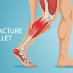 contracture au mollet que faire jambe muscle gastrocnémien douleur